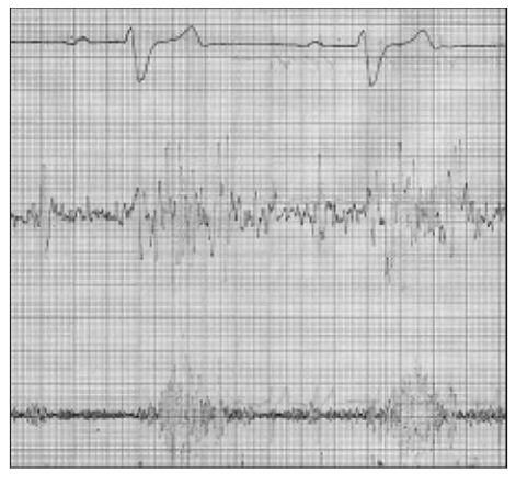 ECG (Lead II, 1 mV/cm, paper speed 100 mm/sec) showing RBBB and Phonocardiogramm 